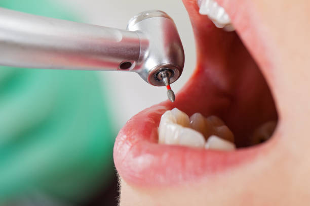 Best Emergency Tooth Extraction in Elk Grove Vlage, IL